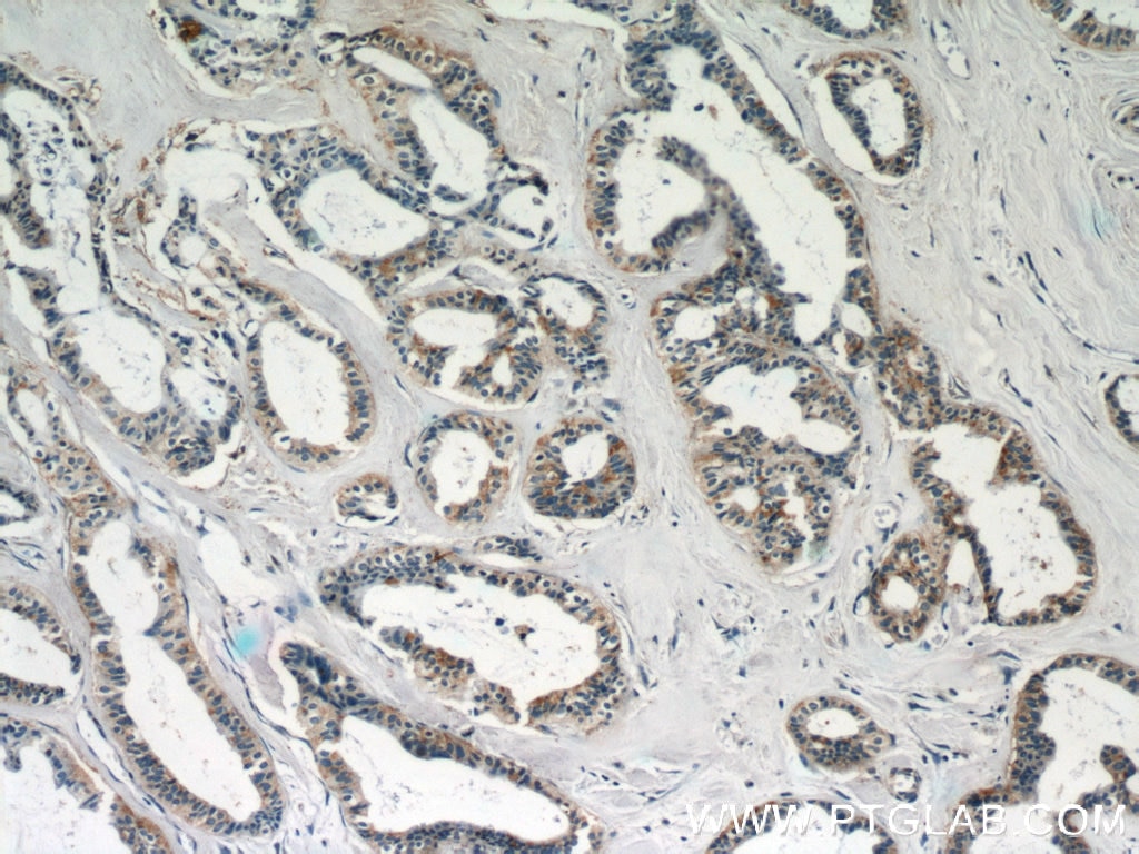 Immunohistochemistry (IHC) staining of human breast cancer tissue using LGALS3BP Polyclonal antibody (23307-1-AP)