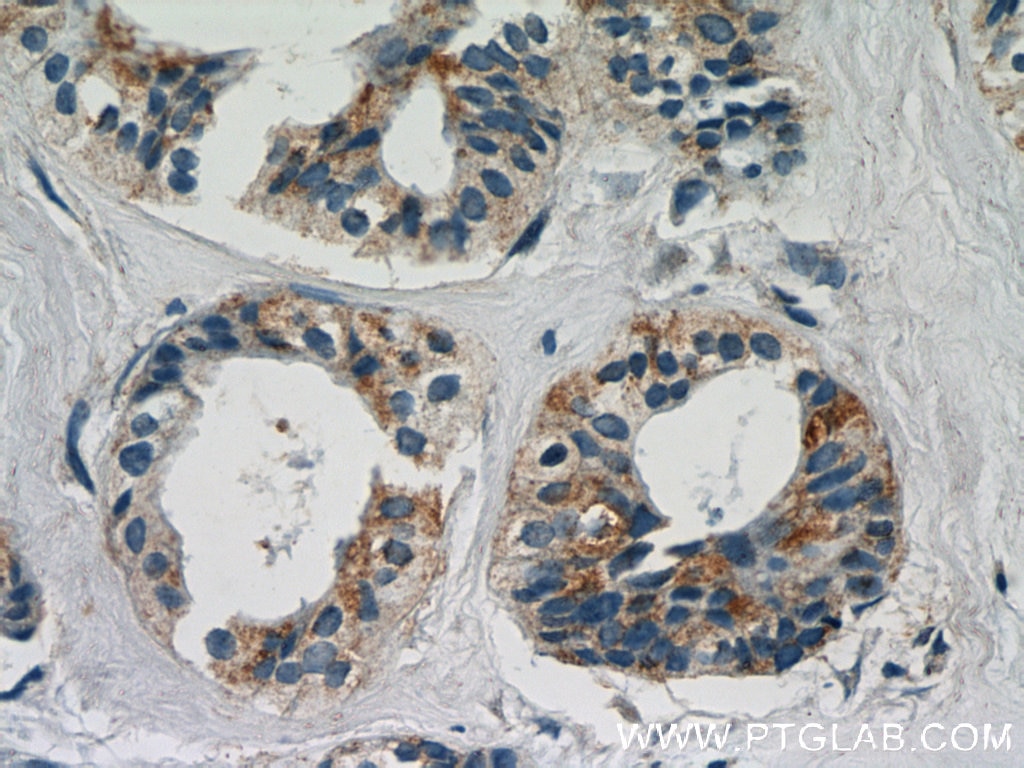 Immunohistochemistry (IHC) staining of human breast cancer tissue using LGALS3BP Polyclonal antibody (23307-1-AP)