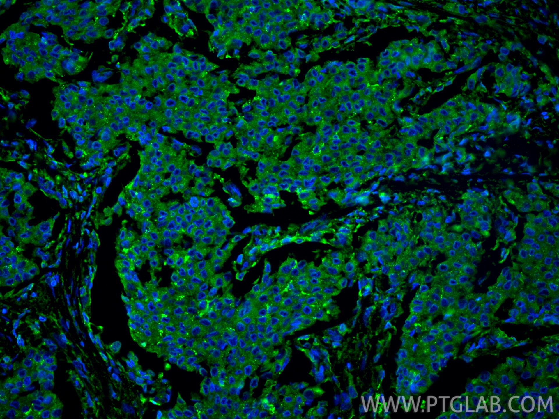 Immunofluorescence (IF) / fluorescent staining of human breast cancer tissue using LGALS3BP Monoclonal antibody (60066-1-Ig)