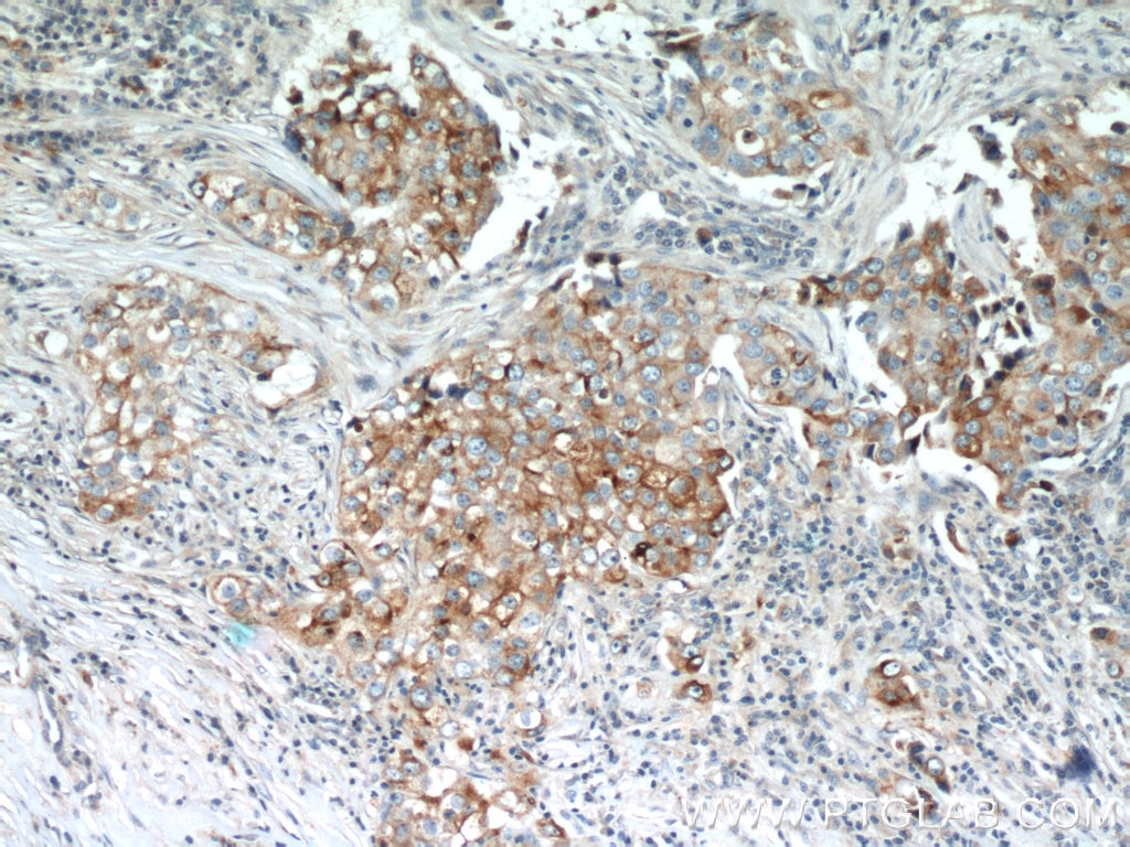 Immunohistochemistry (IHC) staining of human breast cancer tissue using LGALS3BP Monoclonal antibody (60066-1-Ig)