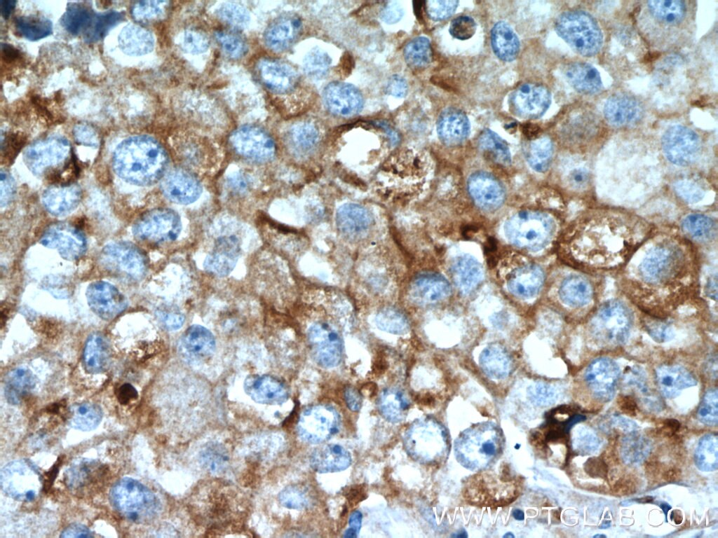 Immunohistochemistry (IHC) staining of human breast cancer tissue using LGALS3BP Monoclonal antibody (60066-1-Ig)