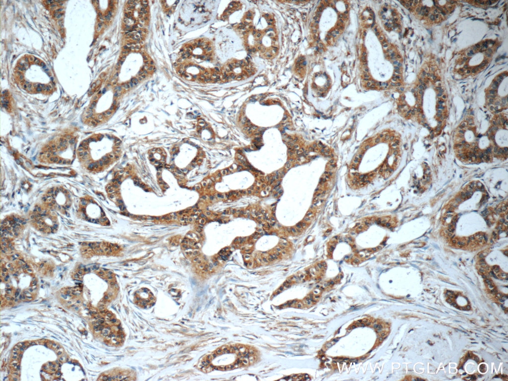 Immunohistochemistry (IHC) staining of human breast cancer tissue using LGALS3BP Monoclonal antibody (60066-1-Ig)