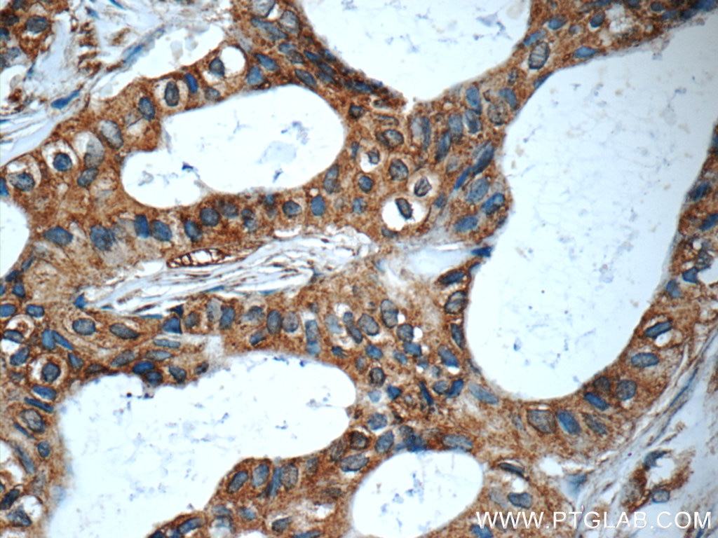 Immunohistochemistry (IHC) staining of human breast cancer tissue using LGALS3BP Monoclonal antibody (60066-1-Ig)