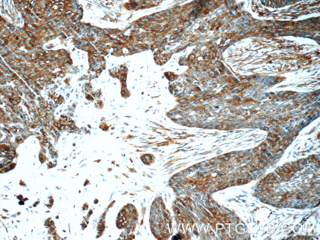 Immunohistochemistry (IHC) staining of human skin cancer tissue using LGALS3BP Monoclonal antibody (60066-1-Ig)