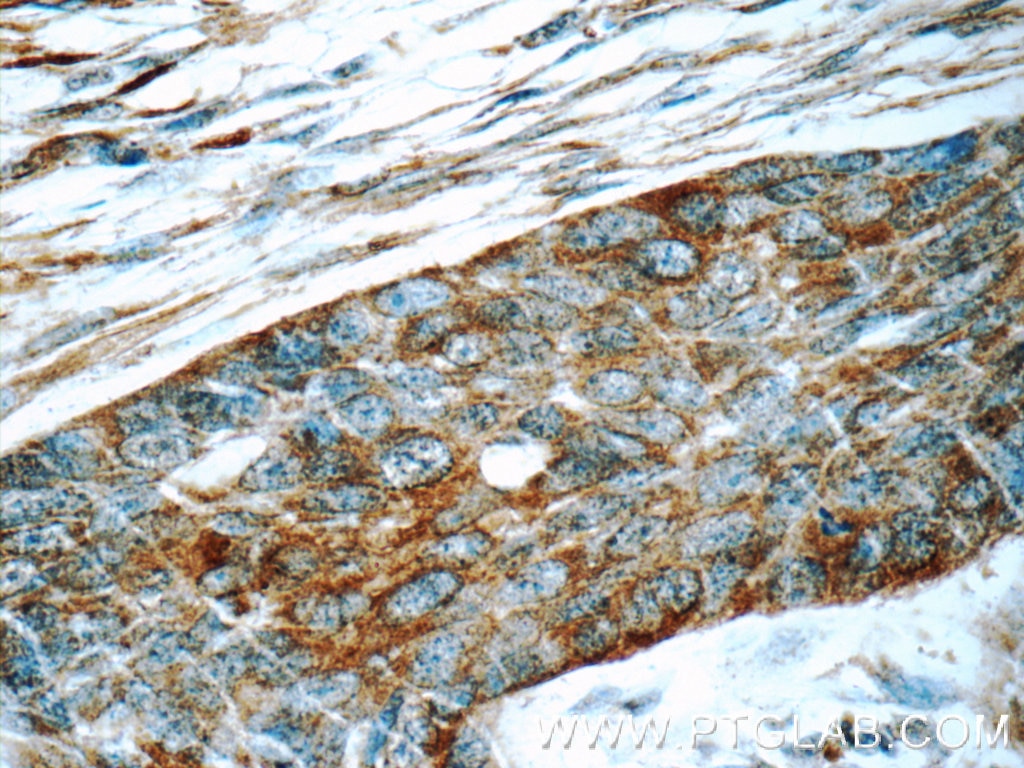 Immunohistochemistry (IHC) staining of human skin cancer tissue using LGALS3BP Monoclonal antibody (60066-1-Ig)