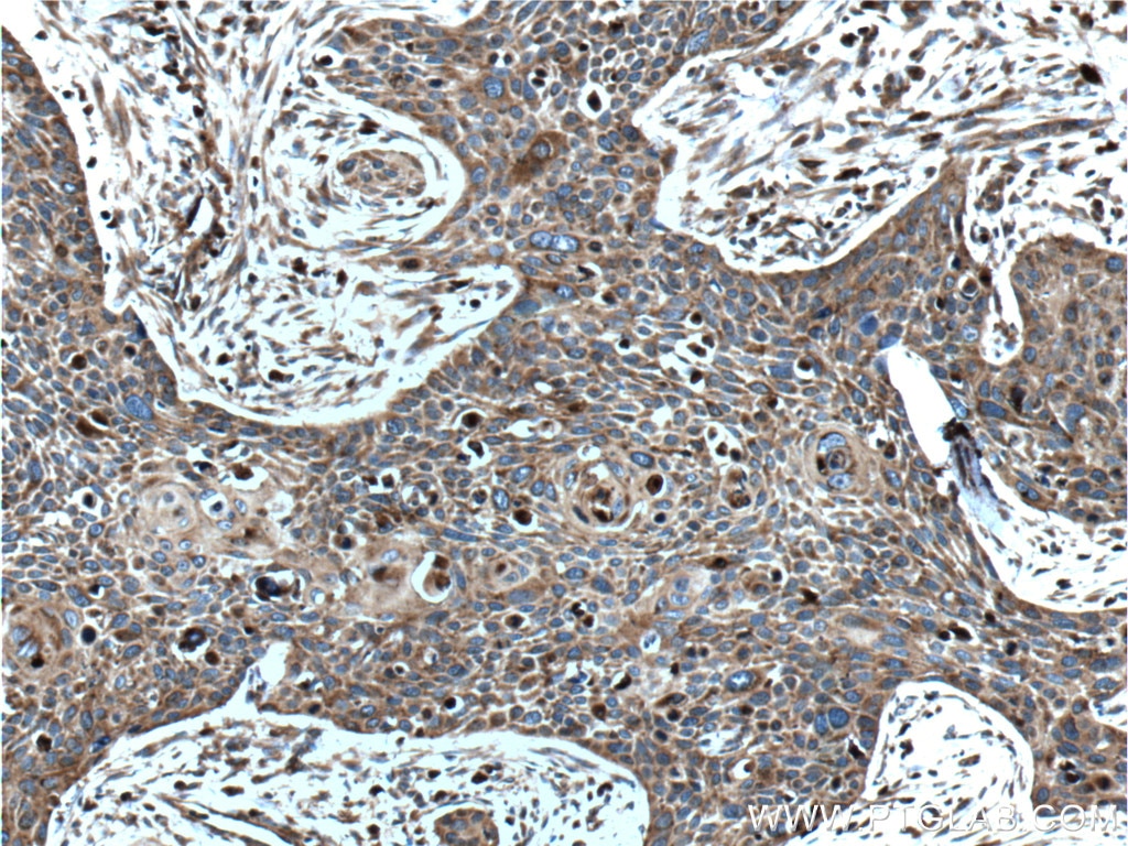 Immunohistochemistry (IHC) staining of human oesophagus cancer tissue using LGALS3BP Monoclonal antibody (60066-1-Ig)