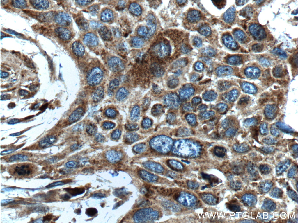 Immunohistochemistry (IHC) staining of human oesophagus cancer tissue using LGALS3BP Monoclonal antibody (60066-1-Ig)