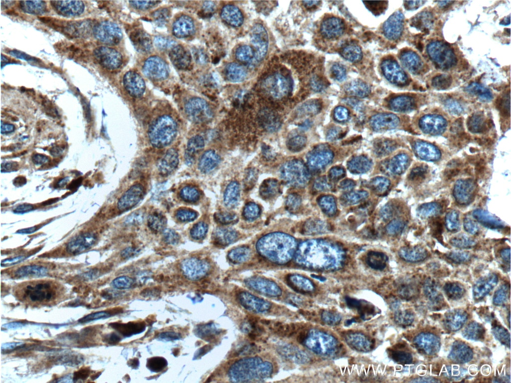 IHC staining of human oesophagus cancer using 60066-1-Ig