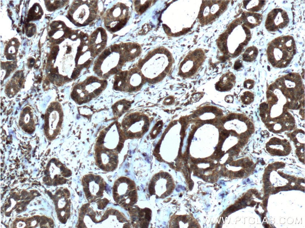 IHC staining of human breast cancer using 60066-1-Ig