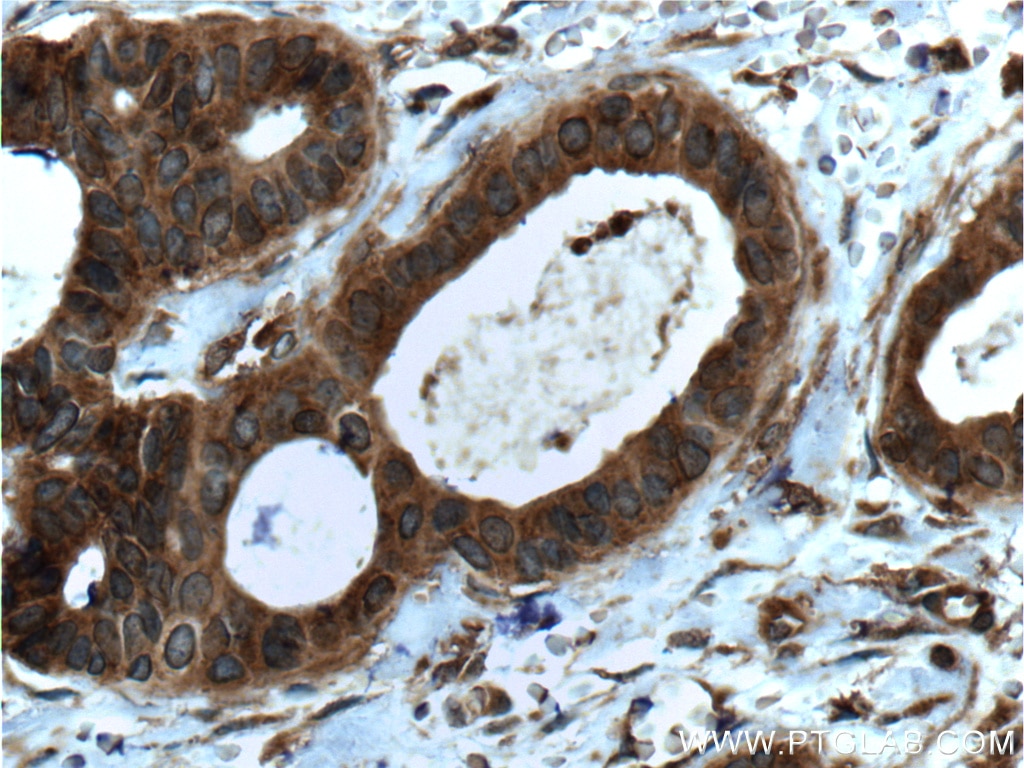 Immunohistochemistry (IHC) staining of human breast cancer tissue using LGALS3BP Monoclonal antibody (60066-1-Ig)