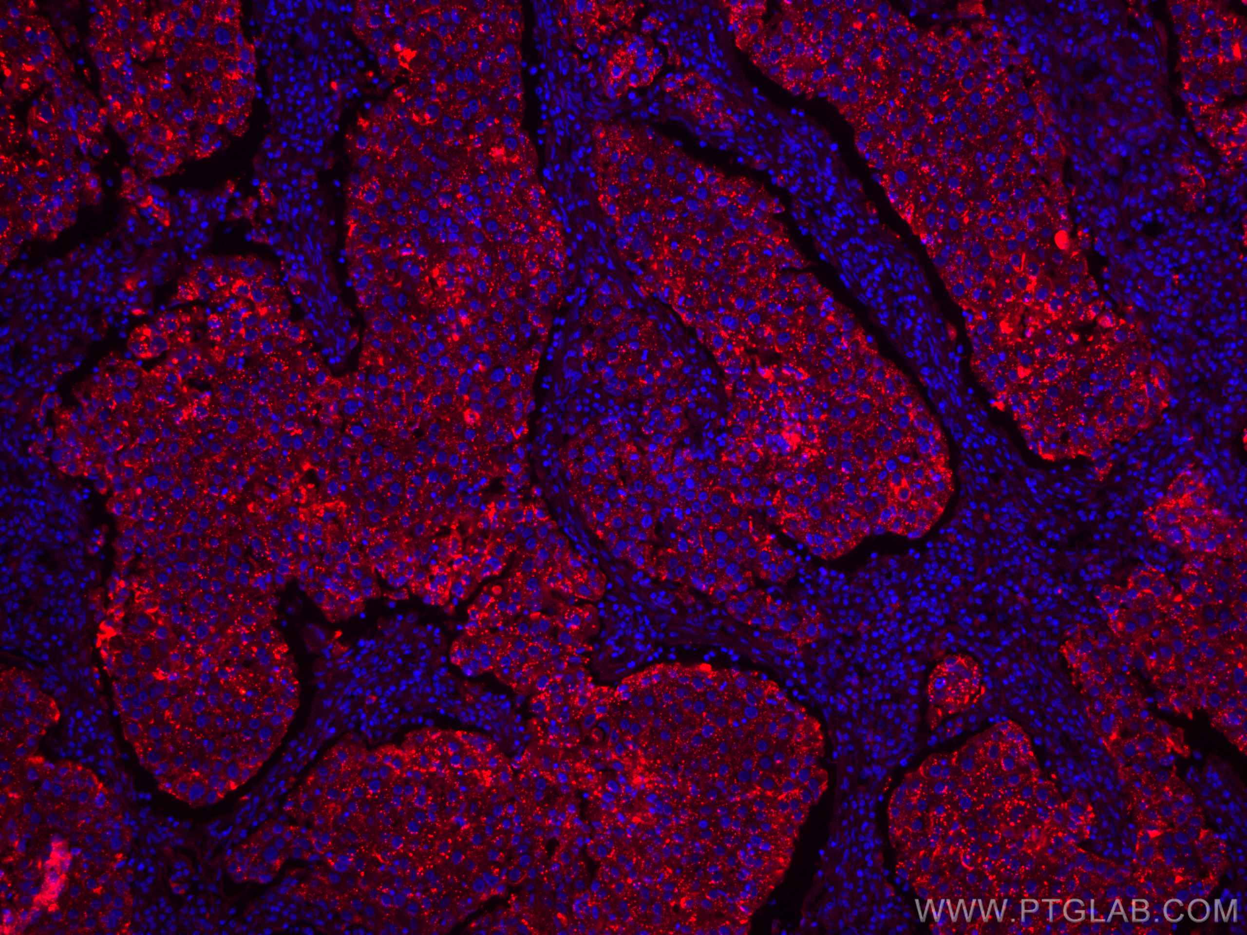 Immunofluorescence (IF) / fluorescent staining of human breast cancer tissue using CoraLite®594-conjugated LGALS3BP Monoclonal antibo (CL594-60066)