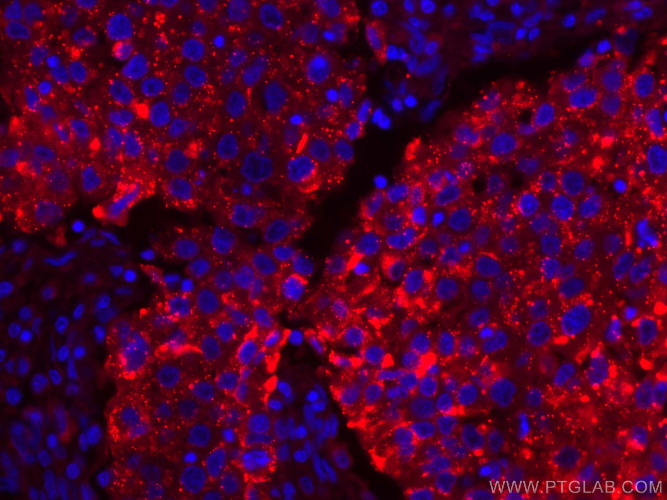 Immunofluorescence (IF) / fluorescent staining of human breast cancer tissue using CoraLite®594-conjugated LGALS3BP Monoclonal antibo (CL594-60066)