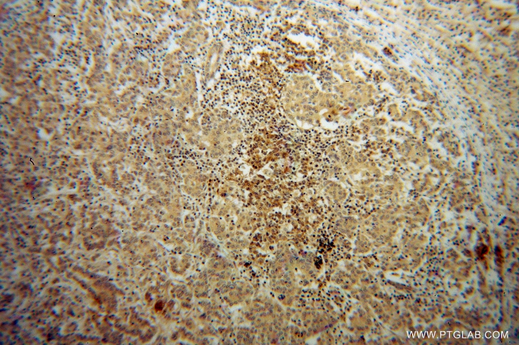 IHC staining of human breast cancer using 13391-1-AP