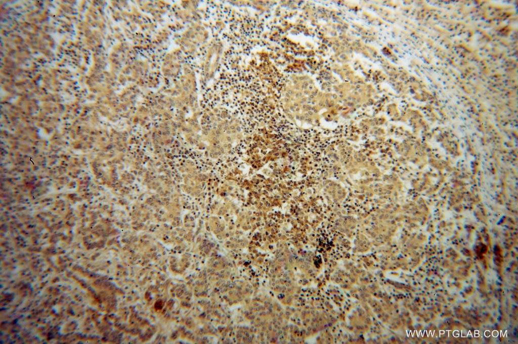 Immunohistochemistry (IHC) staining of human breast cancer tissue using Galectin-4 Polyclonal antibody (13391-1-AP)