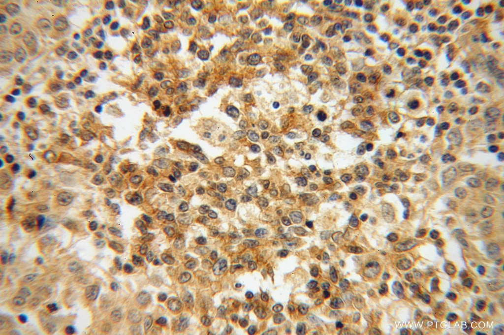 Immunohistochemistry (IHC) staining of human breast cancer tissue using Galectin-4 Polyclonal antibody (13391-1-AP)