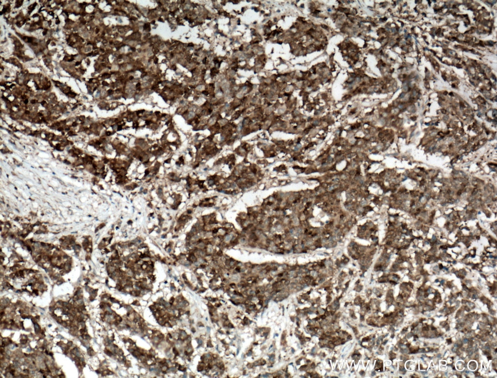 IHC staining of human colon cancer using 27552-1-AP