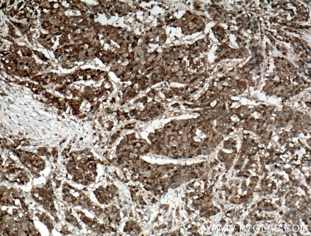Immunohistochemistry (IHC) staining of human colon cancer tissue using Galectin-4 Polyclonal antibody (27552-1-AP)