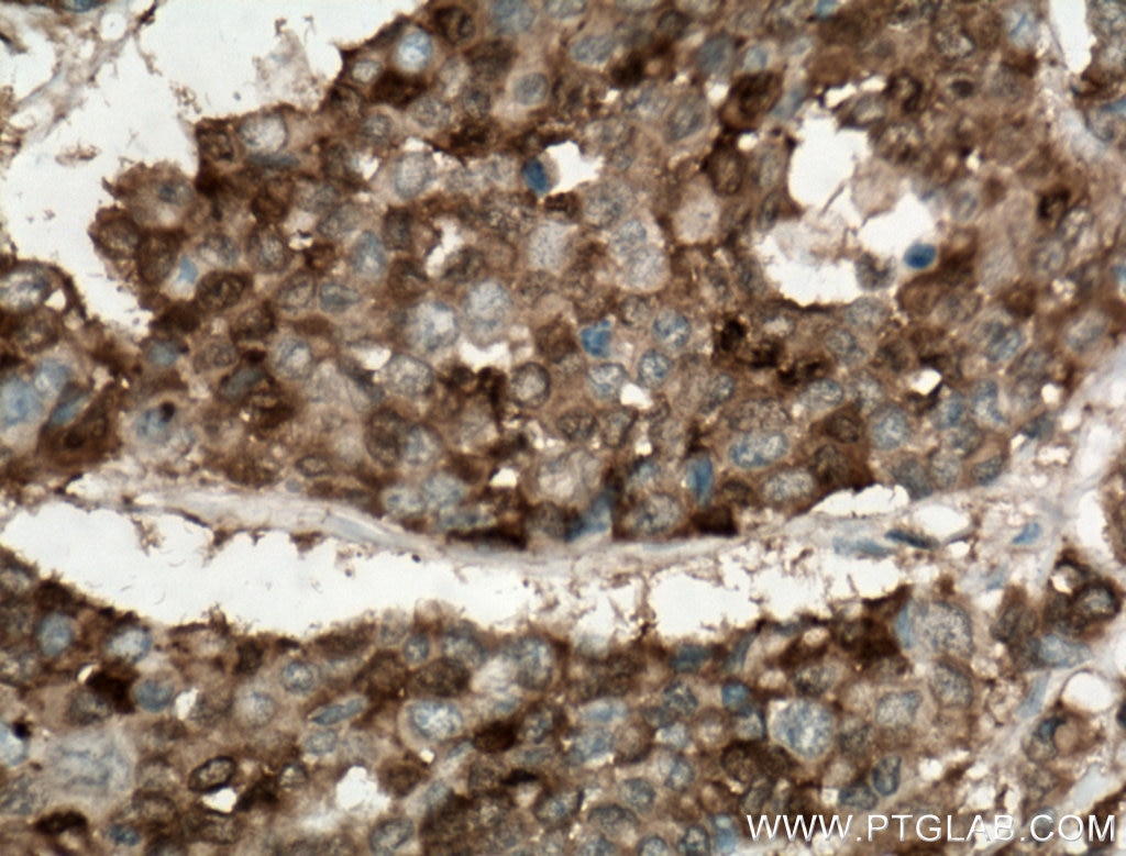 Immunohistochemistry (IHC) staining of human colon cancer tissue using Galectin-4 Polyclonal antibody (27552-1-AP)