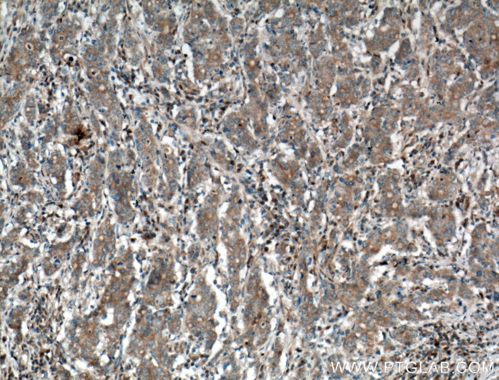 Immunohistochemistry (IHC) staining of human stomach cancer tissue using Galectin-4 Polyclonal antibody (27552-1-AP)
