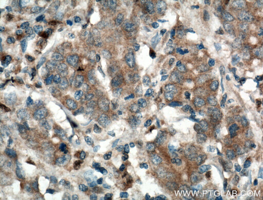 Immunohistochemistry (IHC) staining of human stomach cancer tissue using Galectin-4 Polyclonal antibody (27552-1-AP)