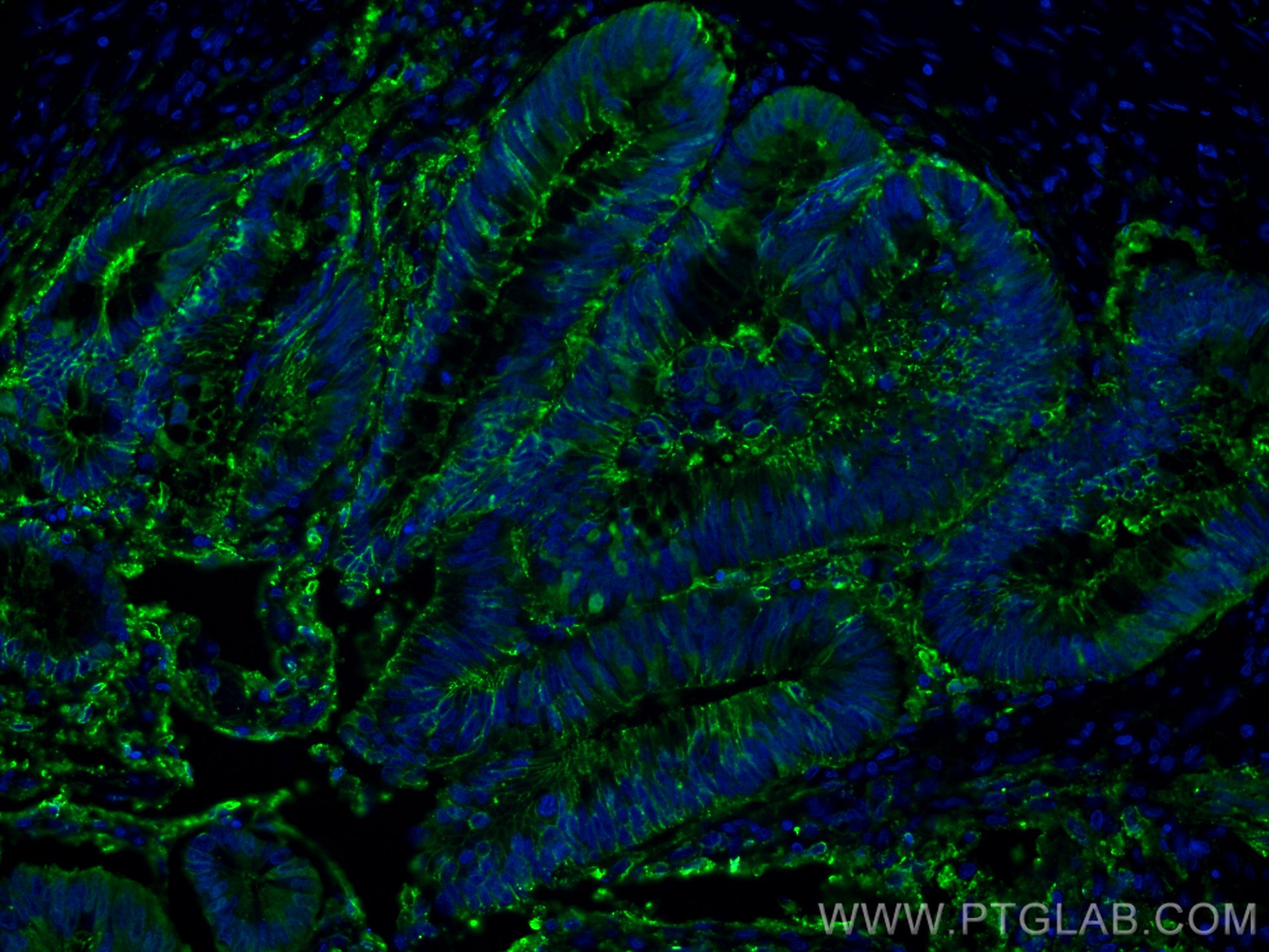 Immunofluorescence (IF) / fluorescent staining of human colon cancer tissue using Galectin-4 Monoclonal antibody (66686-1-Ig)