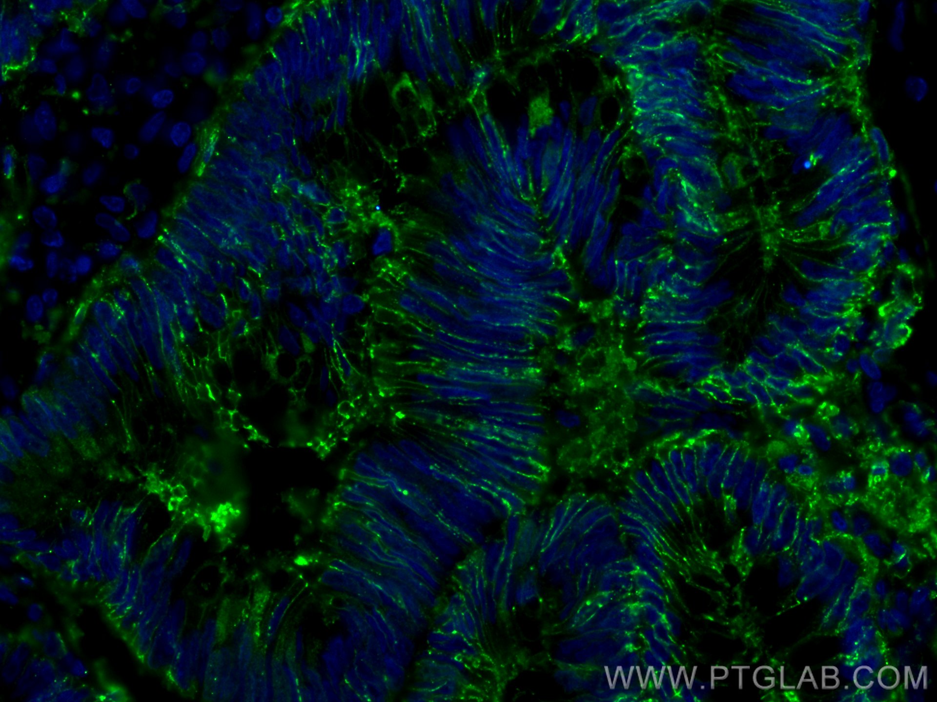 Immunofluorescence (IF) / fluorescent staining of human colon cancer tissue using Galectin-4 Monoclonal antibody (66686-1-Ig)