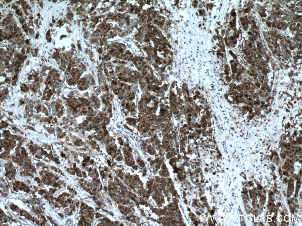 Immunohistochemistry (IHC) staining of human colon cancer tissue using Galectin-4 Monoclonal antibody (66686-1-Ig)