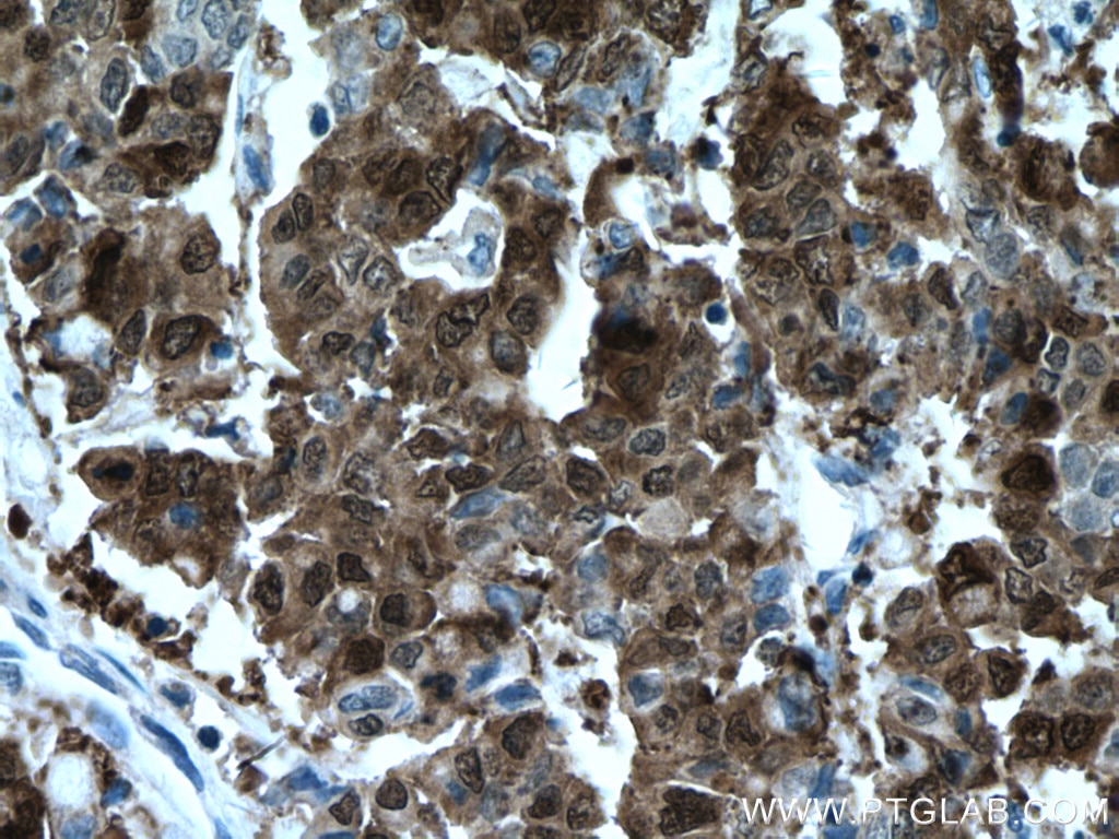 Immunohistochemistry (IHC) staining of human colon cancer tissue using Galectin-4 Monoclonal antibody (66686-1-Ig)