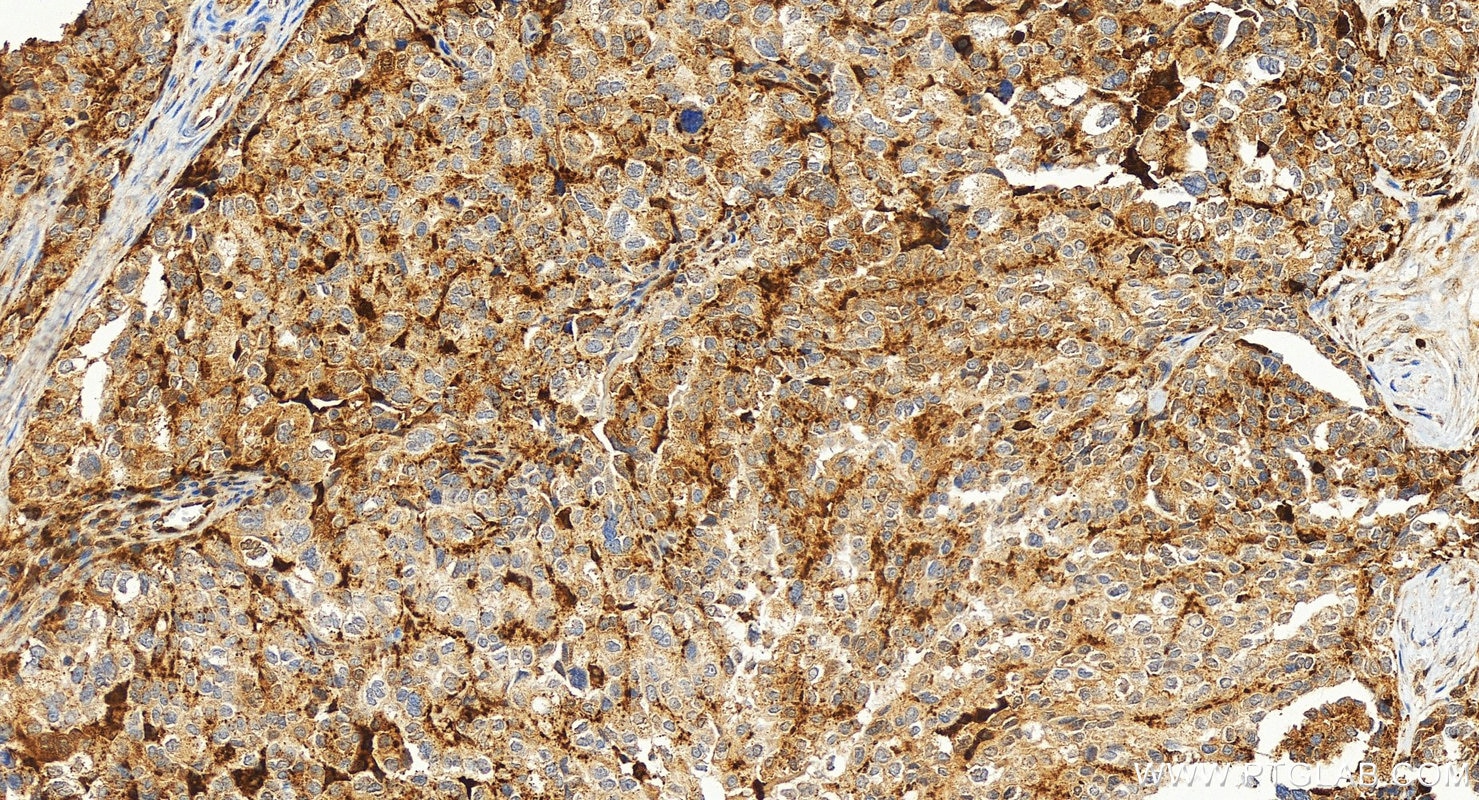 IHC staining of human ovary cancer using 30409-1-AP Immunohistochemistry (IHC) staining of human ovary cancer tissue using LGALS9/Galectin-9 Polyclonal antibody (30409-1-AP)