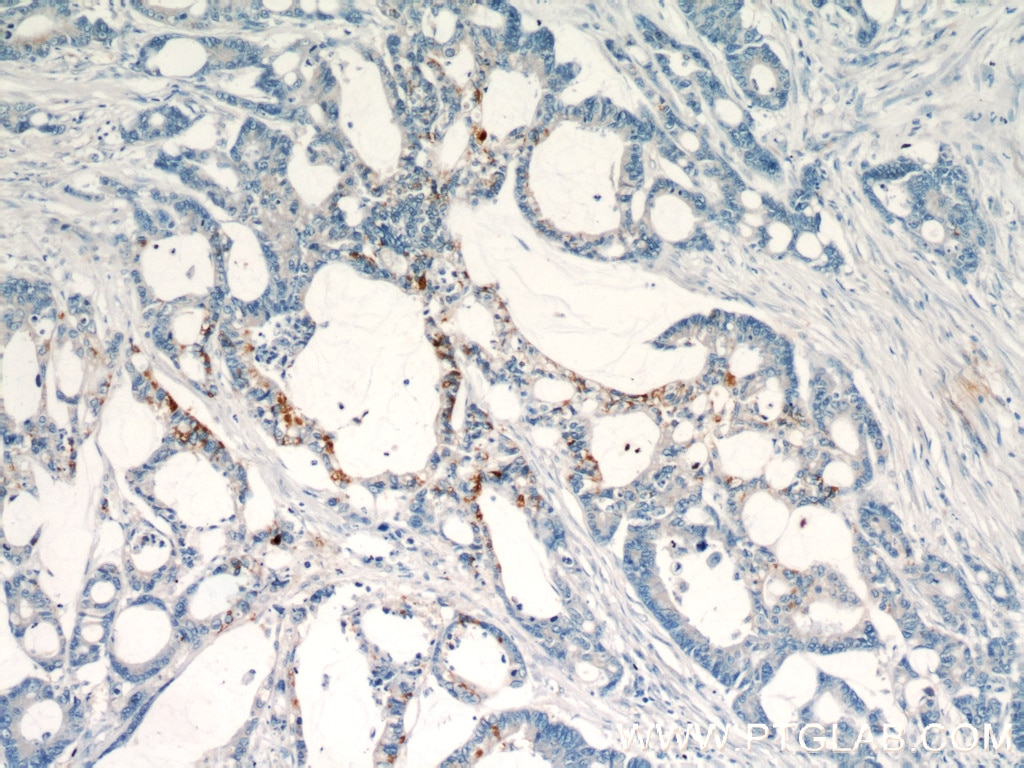 Immunohistochemistry (IHC) staining of human colon cancer tissue using LGR5 Polyclonal antibody (21833-1-AP)