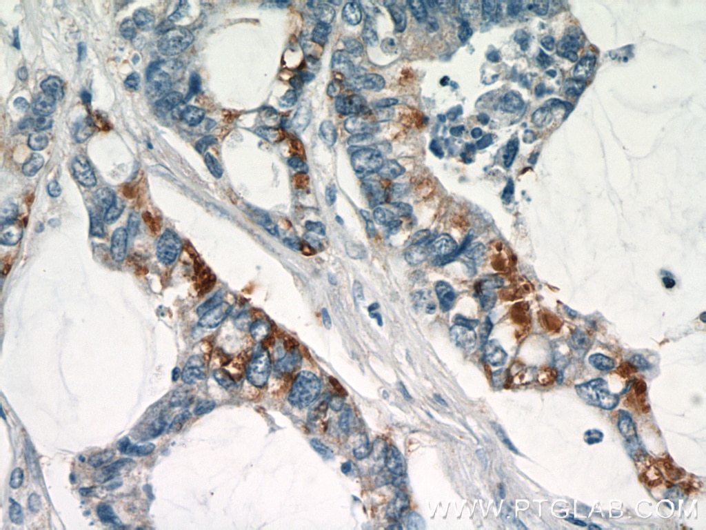 Immunohistochemistry (IHC) staining of human colon cancer tissue using LGR5 Polyclonal antibody (21833-1-AP)