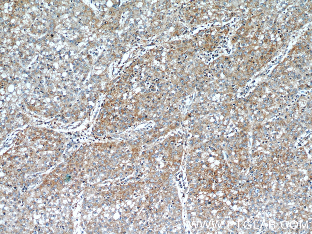 Immunohistochemistry (IHC) staining of human liver cancer tissue using LGR5 Polyclonal antibody (21833-1-AP)