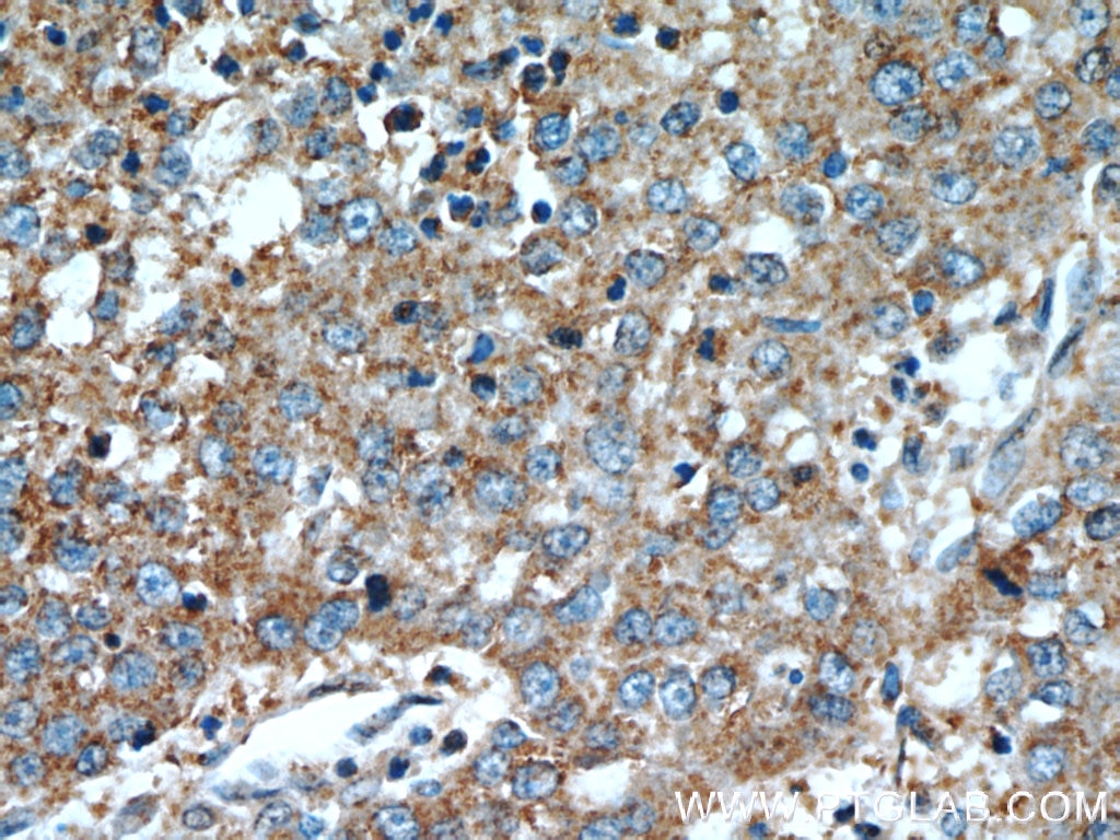 Immunohistochemistry (IHC) staining of human liver cancer tissue using LGR5 Polyclonal antibody (21833-1-AP)