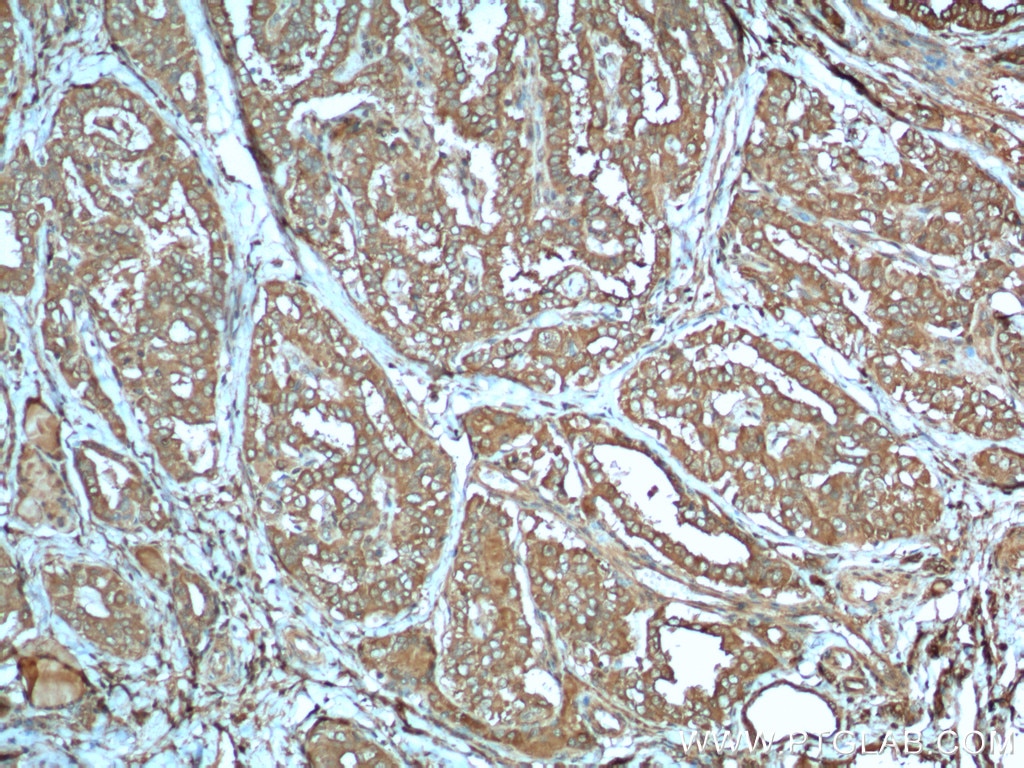IHC staining of human thyroid cancer using 26424-1-AP