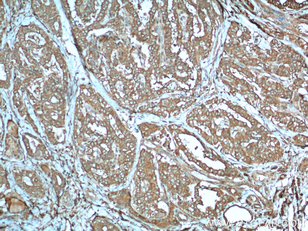 Immunohistochemistry (IHC) staining of human thyroid cancer tissue using LHCGR Polyclonal antibody (26424-1-AP)