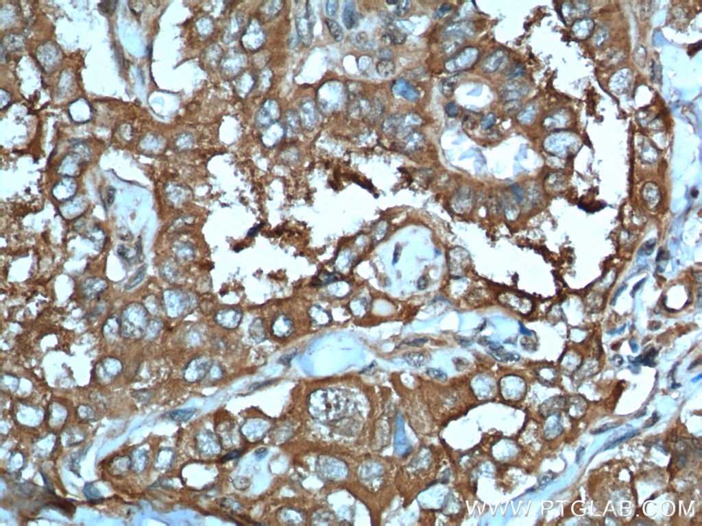 Immunohistochemistry (IHC) staining of human thyroid cancer tissue using LHCGR Polyclonal antibody (26424-1-AP)