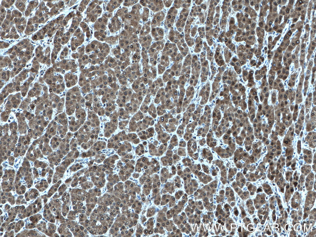 Immunohistochemistry (IHC) staining of human liver cancer tissue using LHPP Polyclonal antibody (15759-1-AP)