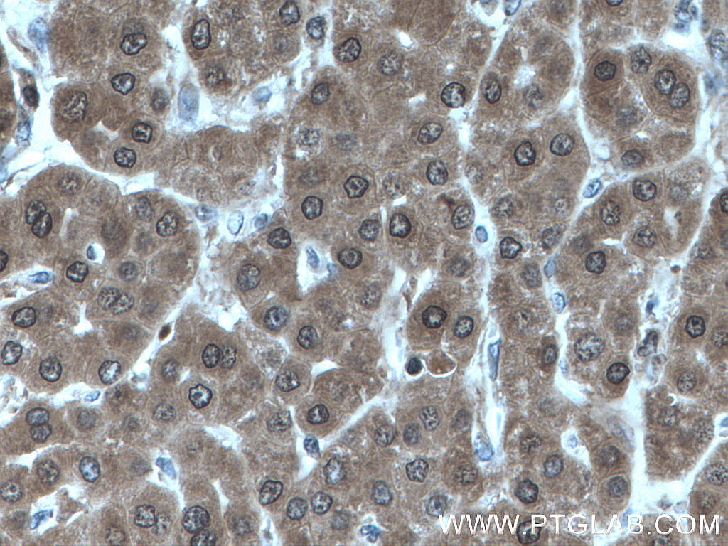 Immunohistochemistry (IHC) staining of human liver cancer tissue using LHPP Polyclonal antibody (15759-1-AP)