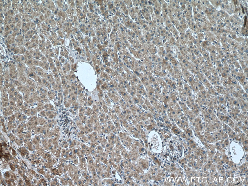 Immunohistochemistry (IHC) staining of human liver cancer tissue using LIAS Polyclonal antibody (11577-1-AP)