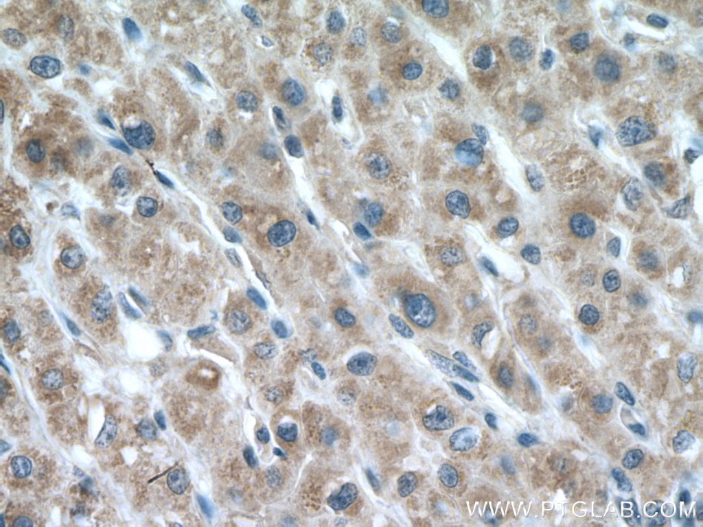 Immunohistochemistry (IHC) staining of human liver cancer tissue using LIAS Polyclonal antibody (11577-1-AP)