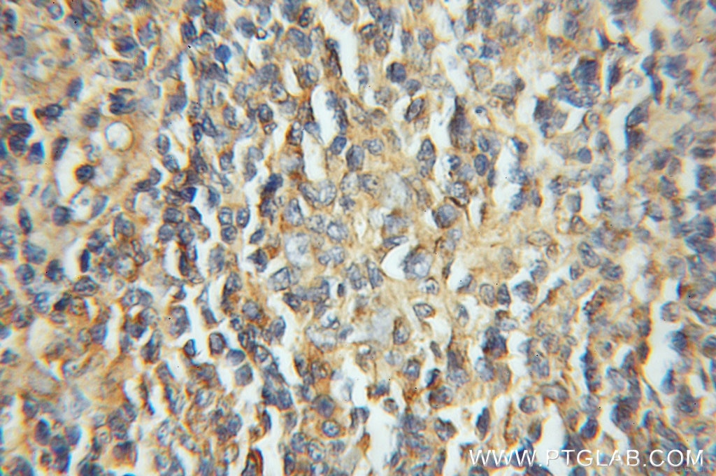 Immunohistochemistry (IHC) staining of human lymphoma tissue using LIAS Polyclonal antibody (11577-1-AP)