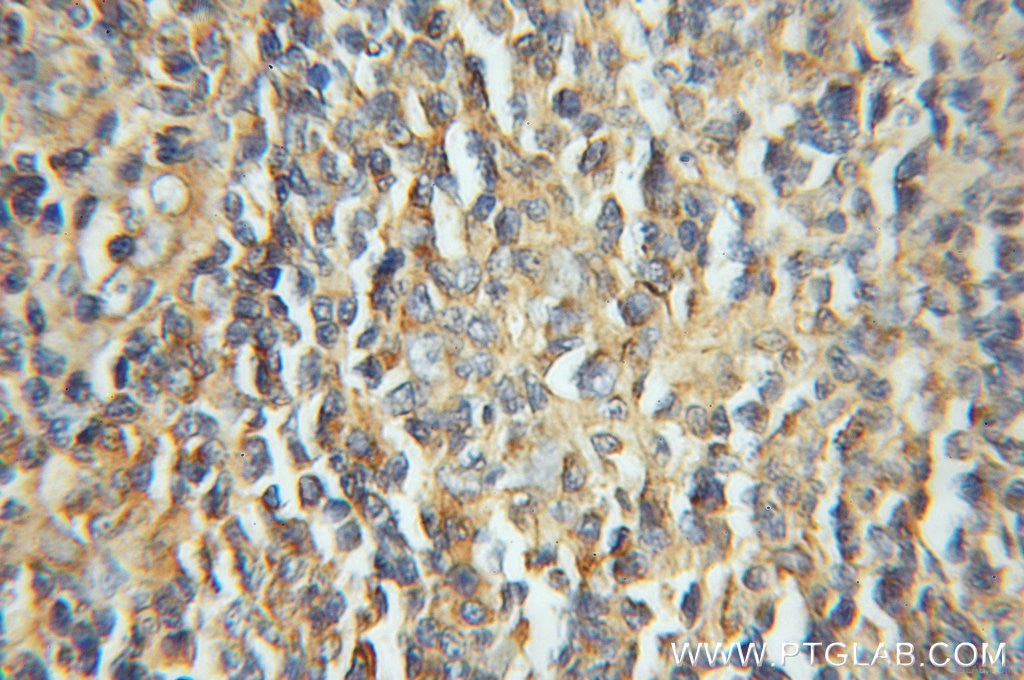 IHC staining of human lymphoma using 11577-1-AP