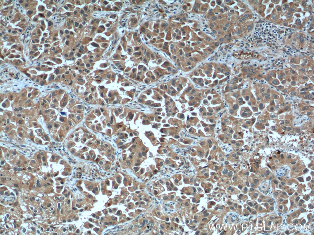 Immunohistochemistry (IHC) staining of human lung cancer tissue using LIF Polyclonal antibody (26757-1-AP)
