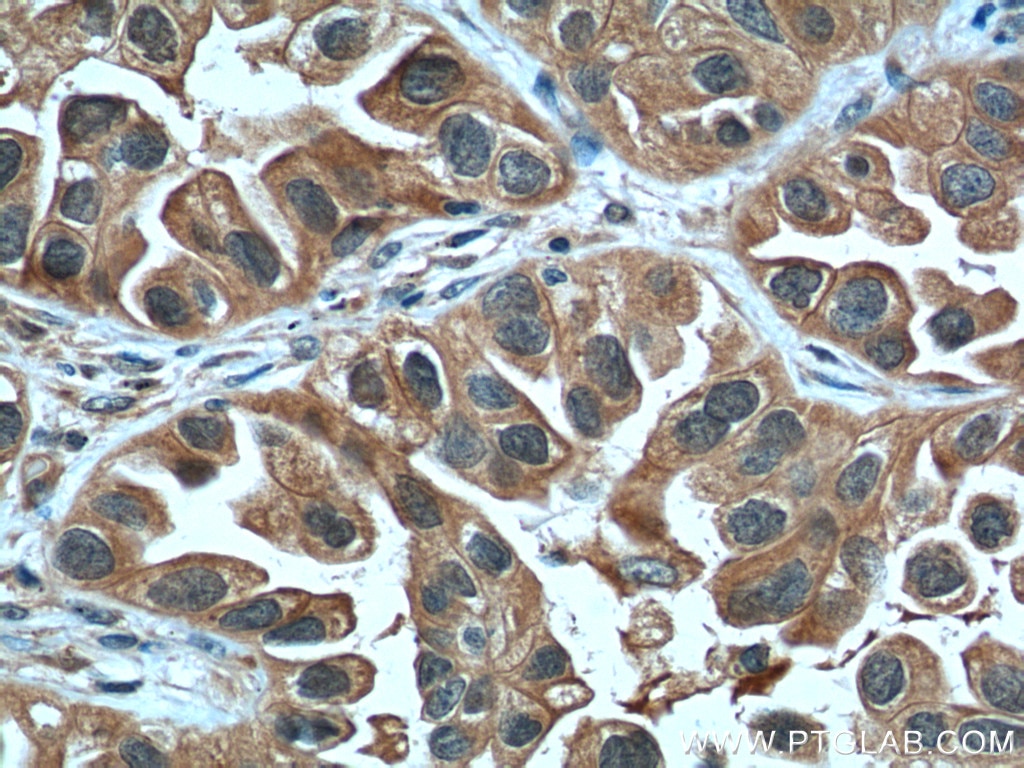 Immunohistochemistry (IHC) staining of human lung cancer tissue using LIF Polyclonal antibody (26757-1-AP)