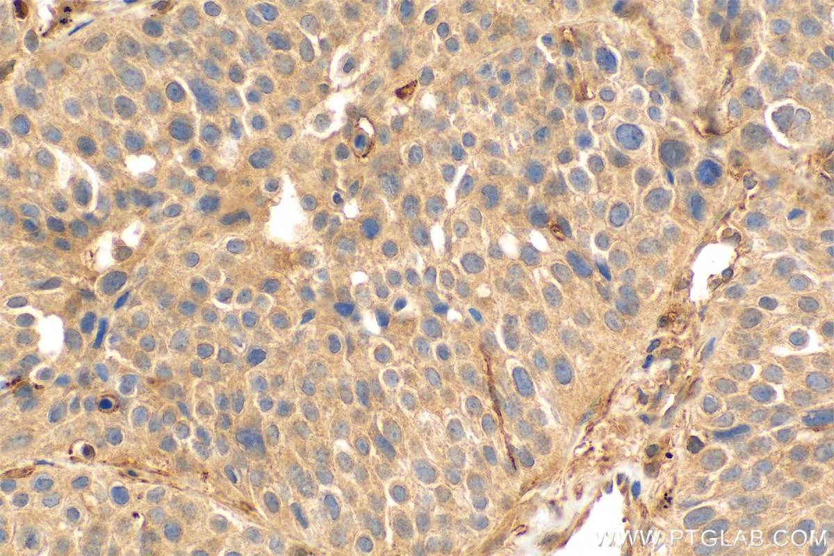 Immunohistochemistry (IHC) staining of human lung cancer tissue using LIF Polyclonal antibody (26757-1-AP)