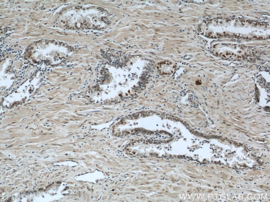 Immunohistochemistry (IHC) staining of human prostate cancer tissue using LIG4 Polyclonal antibody (12695-1-AP)