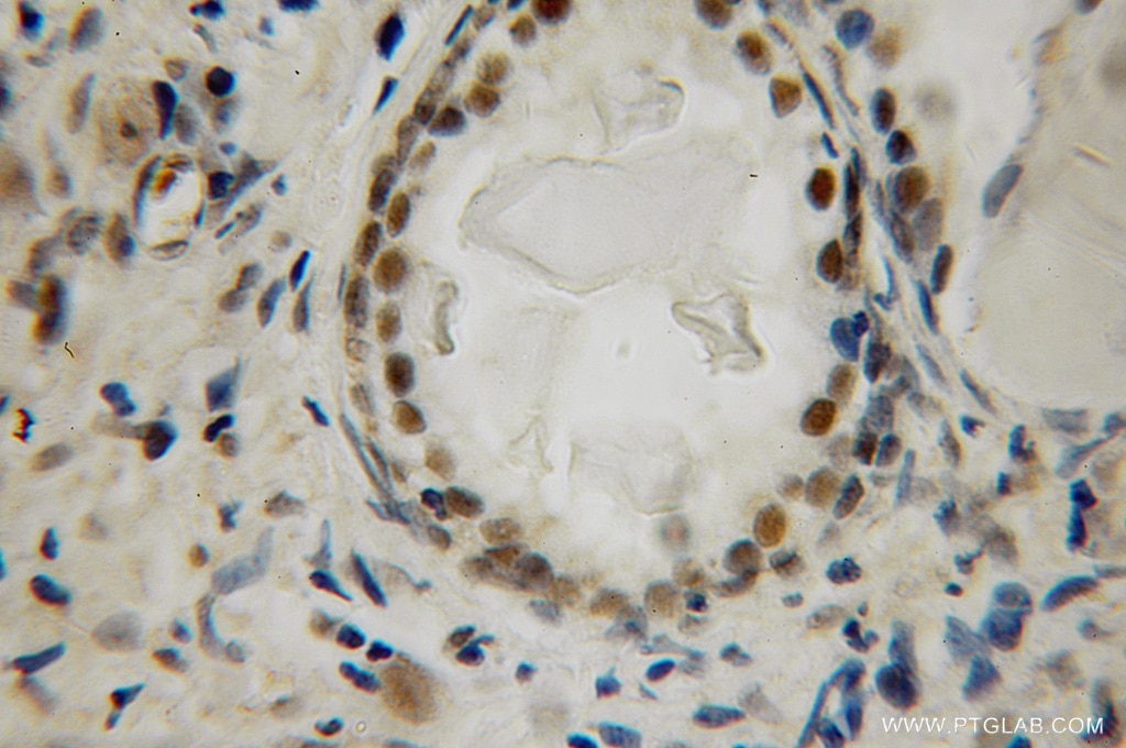 Immunohistochemistry (IHC) staining of human prostate cancer tissue using LIG4 Polyclonal antibody (12695-1-AP)