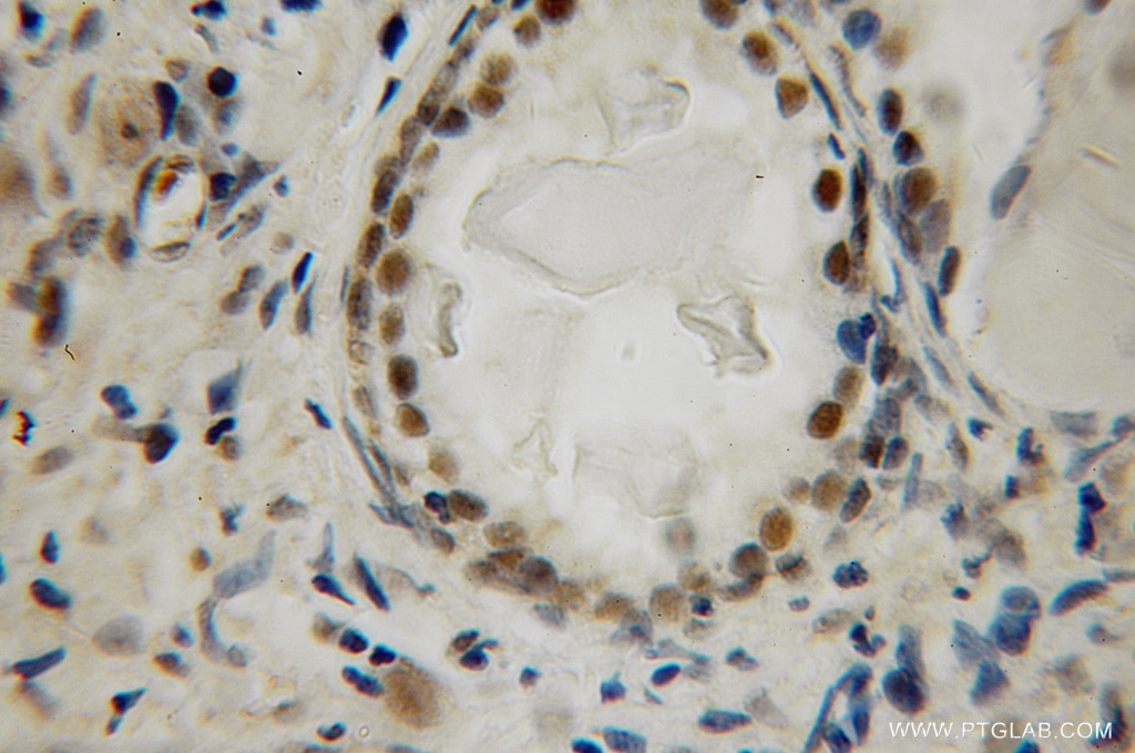 IHC staining of human prostate cancer using 12695-1-AP