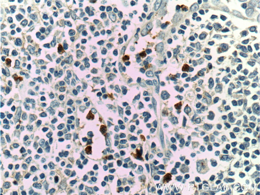 Immunohistochemistry (IHC) staining of human tonsillitis tissue using LILRA2 Polyclonal antibody (11461-1-AP)