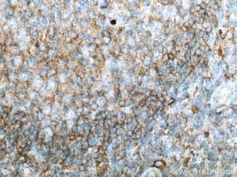 IHC staining of human tonsillitis using 26455-1-AP